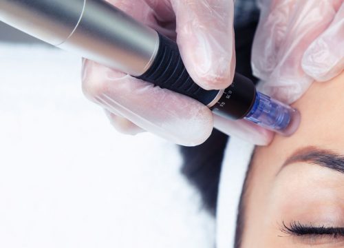 Woman receiving a microneedling treatment